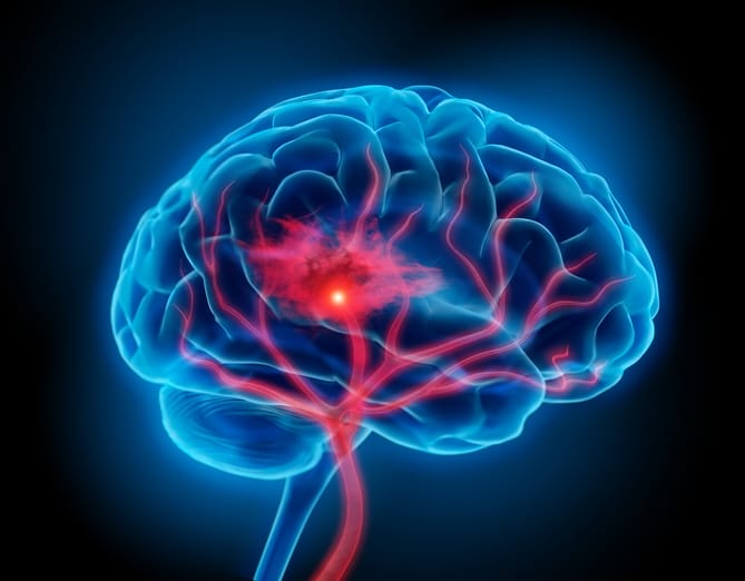 Zonas cerebrales afectadas por un ictus